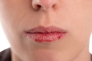 Как вылечить обветренные губы за 1 ночь? Простой рецепт