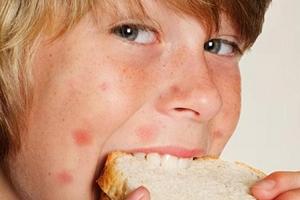 Какие продукты вызывают аллергию? Простой домашний тест