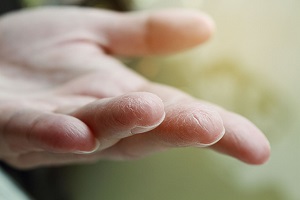 Сухая кожа рук – проблема карантина. Как увлажнить кожу?