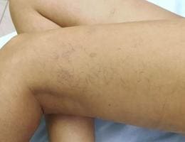 3 скрытые причины возникновения варикоза на ногах у женщин