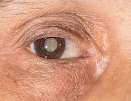 Лечение катаракты семенами укропа. Простой рецепт
