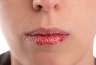 Как защитить губы от обветривания зимой: 4 варианта